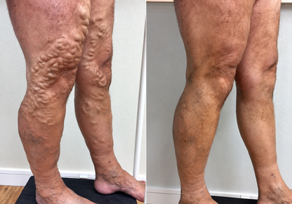 Lyyeto® Varicose Veins Cream – Daily Leg Care & Skin Comfort, 20g