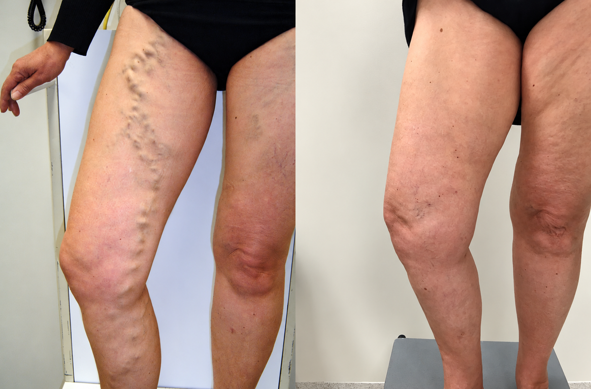Lyyeto® Varicose Veins Cream – Daily Leg Care & Skin Comfort, 20g