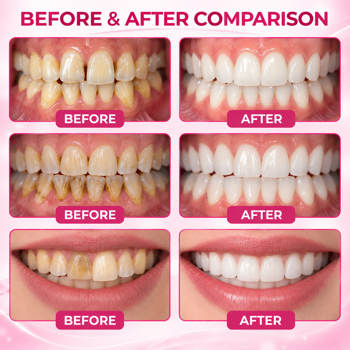 LUHAKA® DenPerm Cavity-Repair Gel