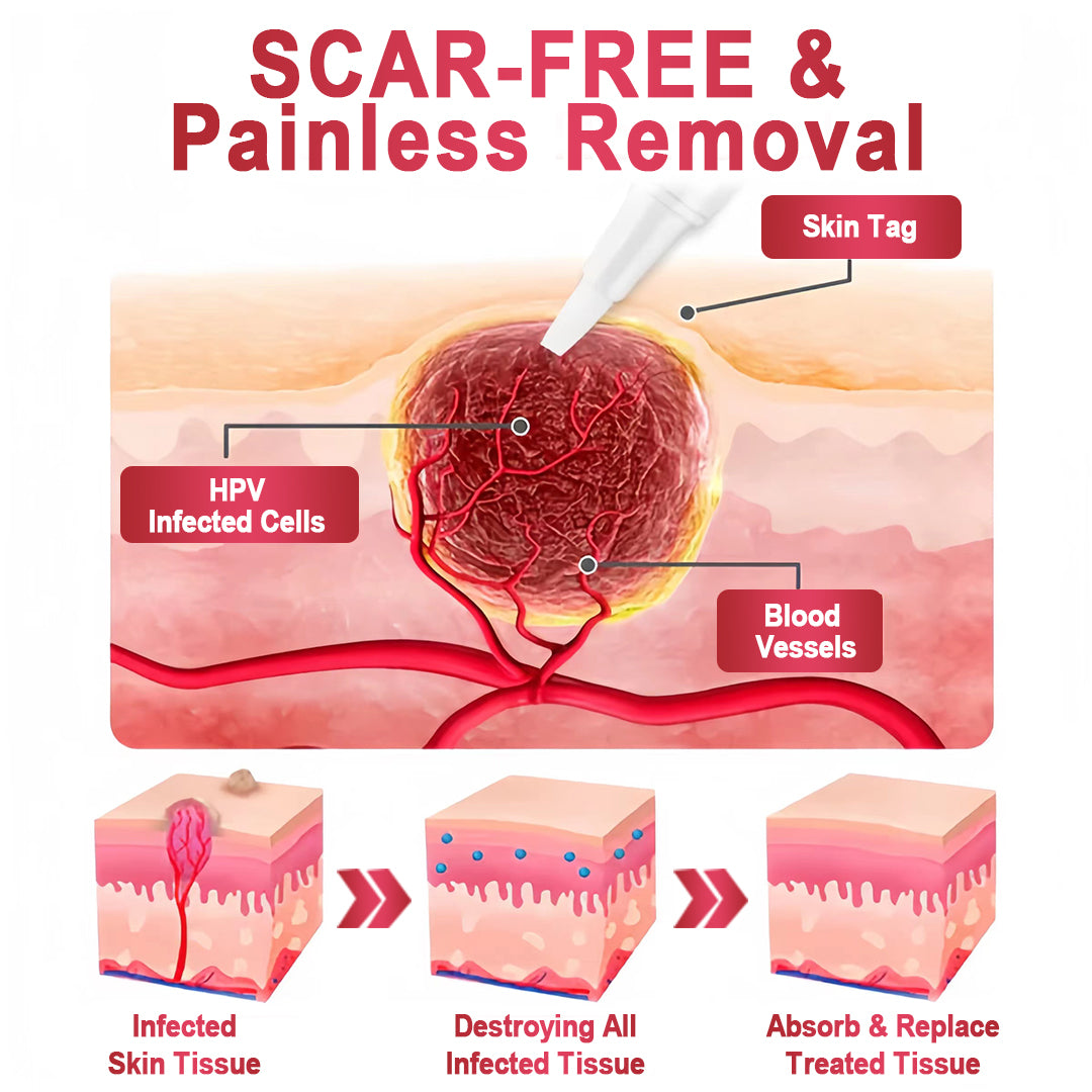 ✨KISSHI™ WipeOffEase Tags & Moles Remover ✨