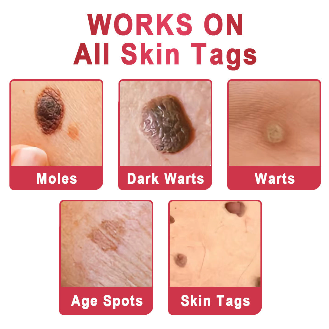 ✨KISSHI™ WipeOffEase Tags & Moles Remover ✨