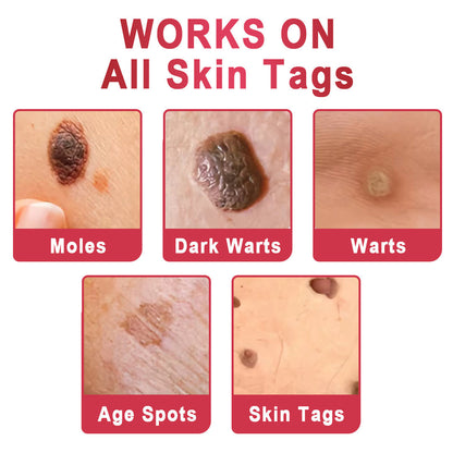✨KISSHI™ WipeOffEase Tags & Moles Remover ✨