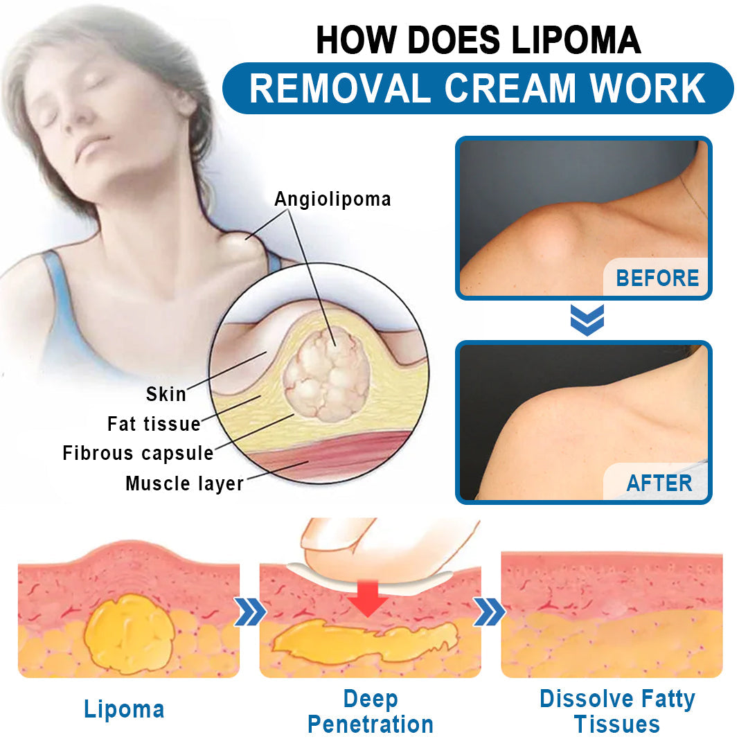🔥Enjoy Discounts💛KISSHI™ Lipoma Removal Cream
