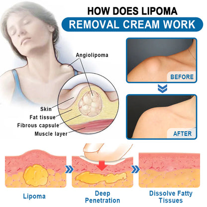 🔥Enjoy Discounts💛KISSHI™ Lipoma Removal Cream
