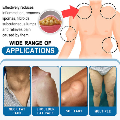 🔥Enjoy Discounts💛KISSHI™ Lipoma Removal Cream