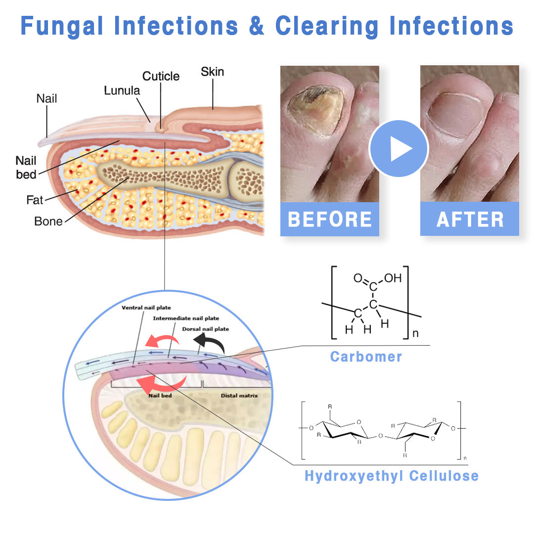 Kisshi™ High-Efficiency Nail Fungus Cold Light Therapy Device