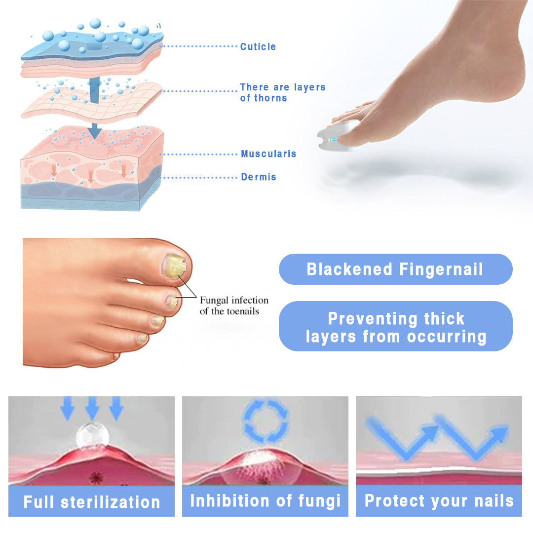 Kisshi™ High-Efficiency Nail Fungus Cold Light Therapy Device