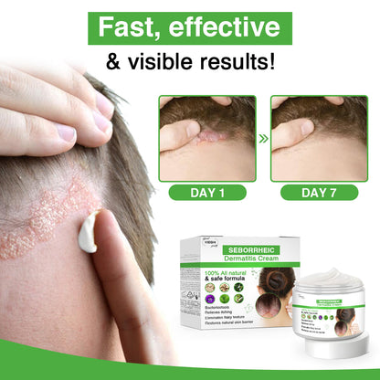 Kisshi™ Seborrheic Dermatitis Cream