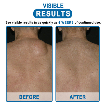 🔥Enjoy Discounts💛KISSHI™ Lipoma Removal Cream
