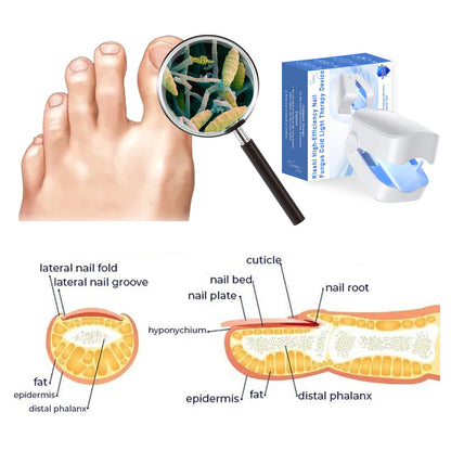 Kisshi™ High-Efficiency Nail Fungus Cold Light Therapy Device