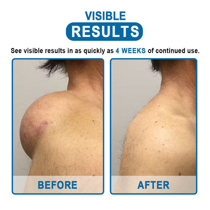 🔥Enjoy Discounts💛KISSHI™ Lipoma Removal Cream
