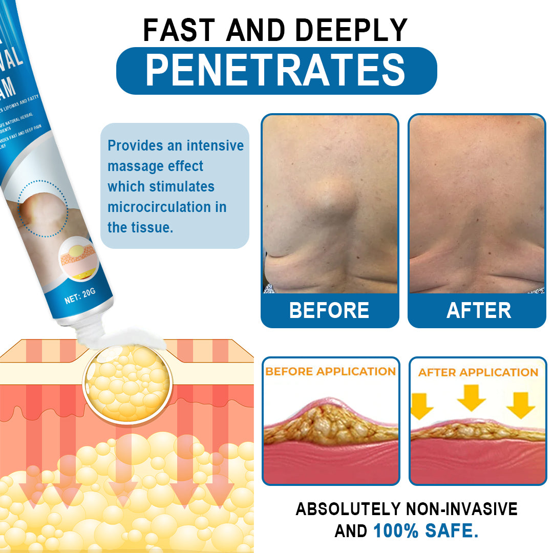 🔥Enjoy Discounts💛KISSHI™ Lipoma Removal Cream