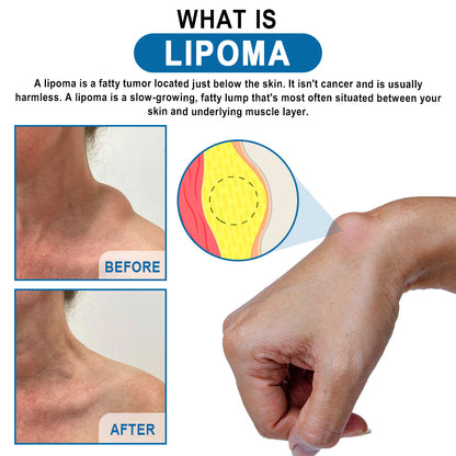 🔥Enjoy Discounts💛KISSHI™ Lipoma Removal Cream